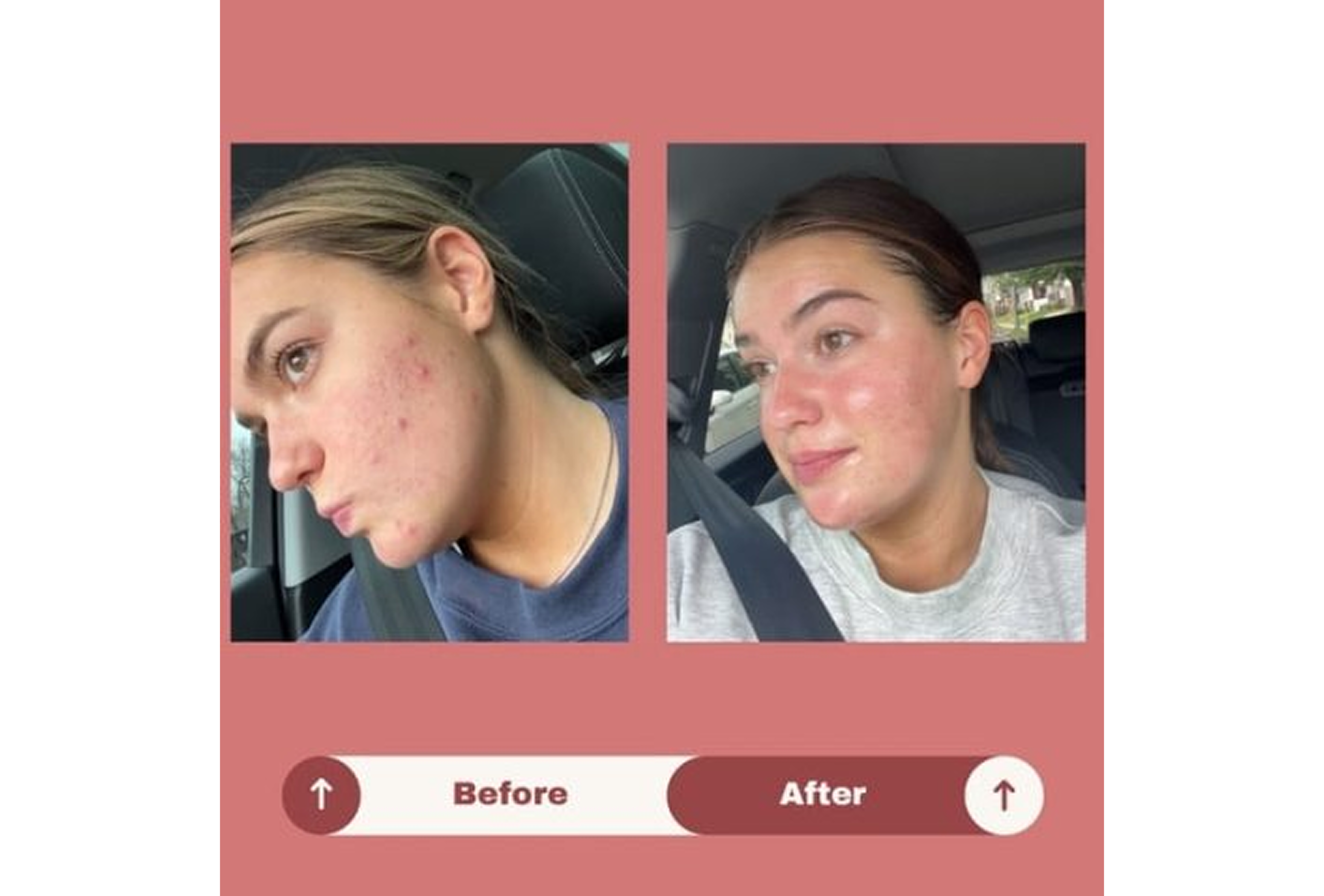 Acne Texture